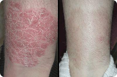 does psoriasis free for life work