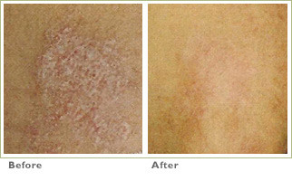 how to get rid of psoriasis naturally