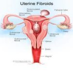 natural holistic uterine fibroids treatment