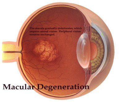 how to cure macular degeneration