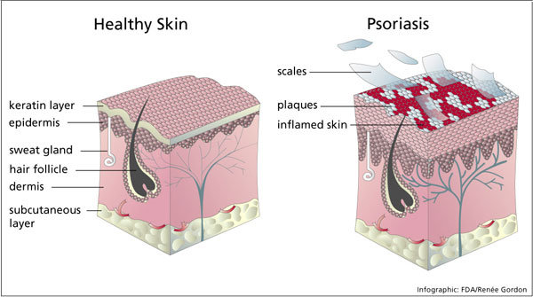 tips to alleviate psoriasis