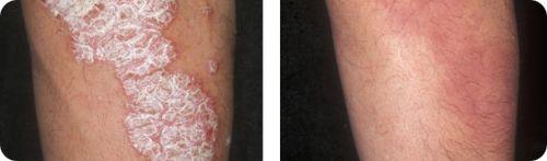 how to cure psoriasis permanently