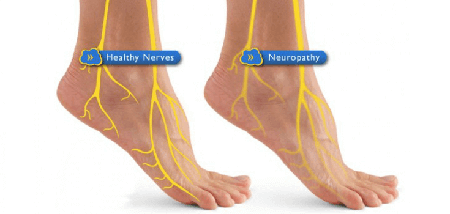 how to get rid of neuropathy