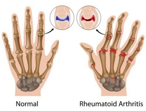 arthritis home remedy for hands