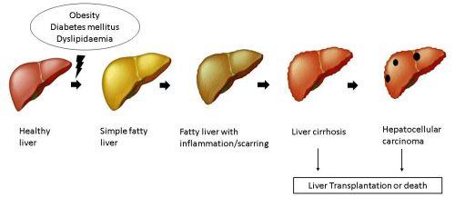 nonalcoholic fatty liver disease treatments